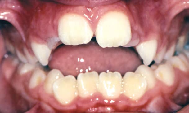 Open Bite Modern Smiles Orthodontics in Fort Myers, FL