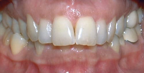 Overbite Modern Smiles Orthodontics in Fort Myers, FL